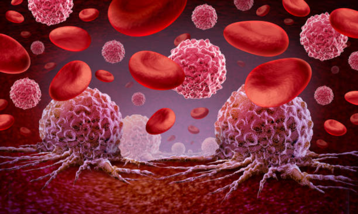 Blood cancer treatment in Bangalore