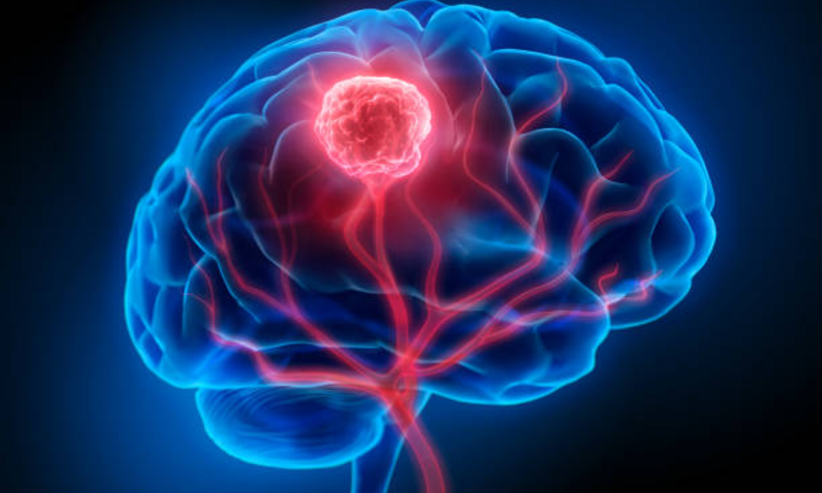 Brain Tumor treatment in Bangalore