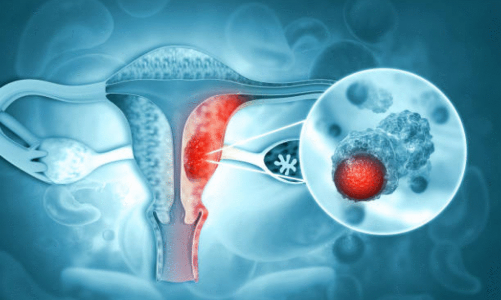 Gynecologic cancer treatment in Bangalore