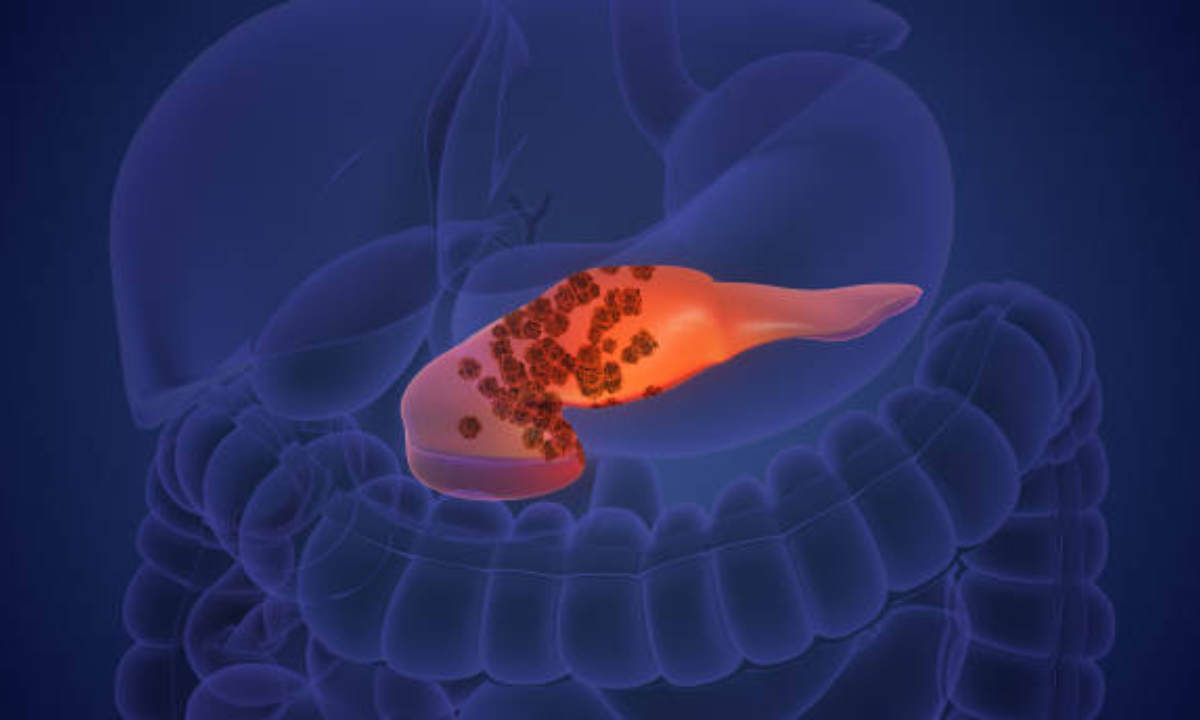 Gastric cancer treatment in Bangalore