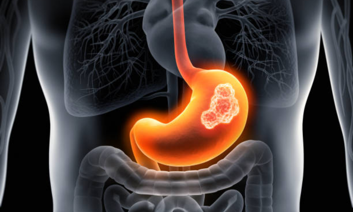Gastric Cancer treatment in Bangalore