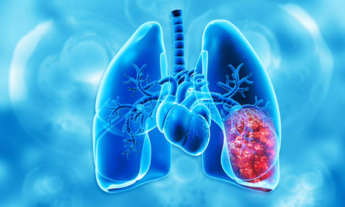 d lung cancer treatment in Bangalore