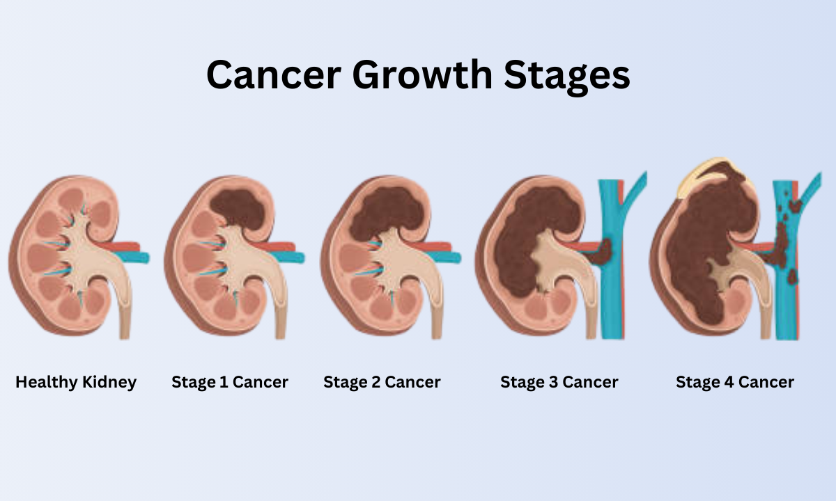 Best cancer hospital in Bangalore
