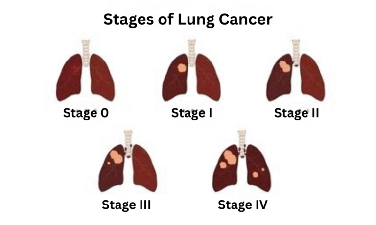 Lung Cancer – Symptoms, Stages, Diagnosis and Treatment Methods