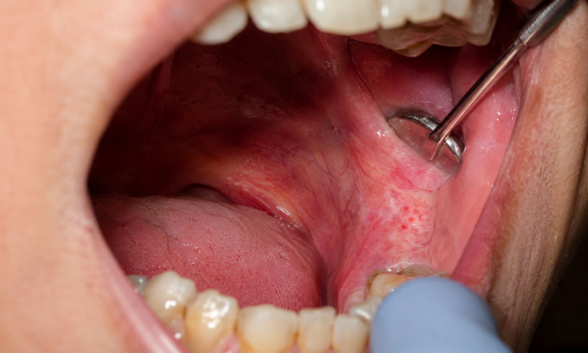 Retromolar Trigone